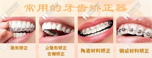 有种尴尬叫深圳盐田区牙科医院的牙齿矫正器价格又变啦