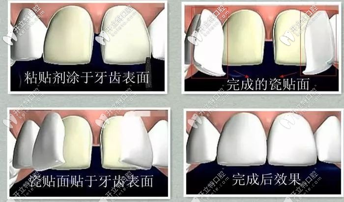 成年人门牙牙缝大怎么修复好?去做矫正还是贴面