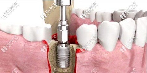 再结合东方人的生理特征精准的植入牙齿,从缺牙找原因,检测,诊断,种植