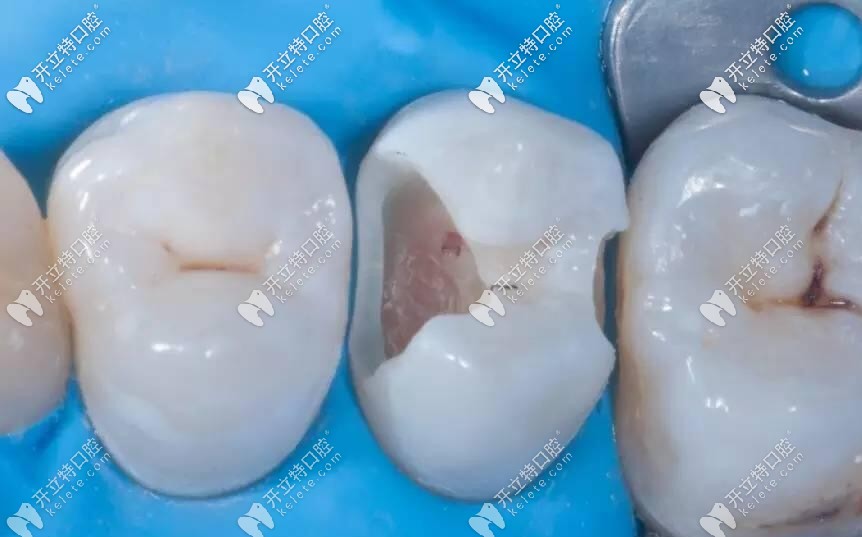 活髓牙做嵌体修复好还是树脂补牙好了解区别和优缺点