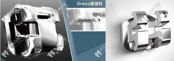 美国奥美科damonq自锁托槽