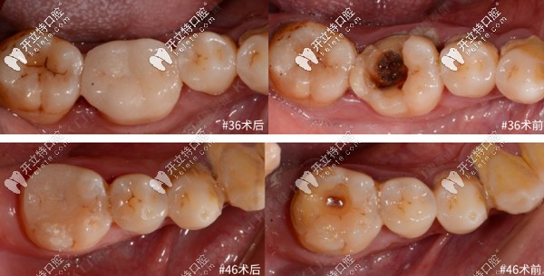 牙齿大面积缺损,用康泰健格莱美瓷嵌体修复案例分享