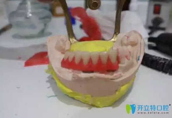 南通摩尔口腔牙齿种植术后牙模
