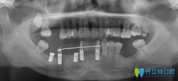 南通摩尔口腔牙齿种植前检查