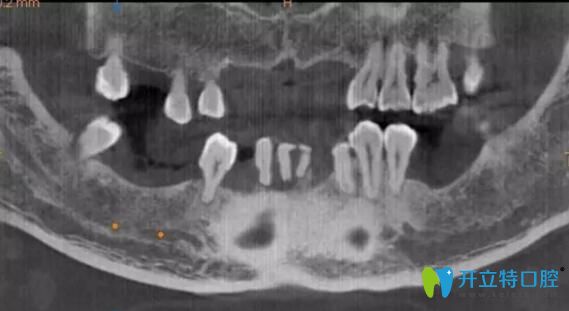 南通摩尔口腔牙齿缺失怎么办？看看南通摩尔口腔数字化种植牙你就知道