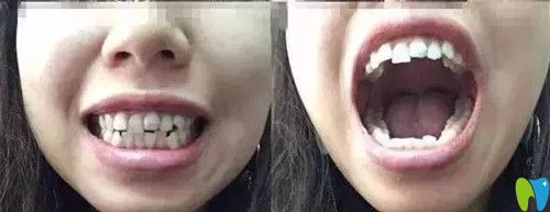 牙齿矫正前排列错乱
