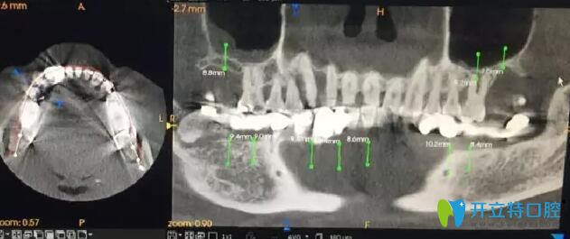 南通摩尔口腔术前手术设计