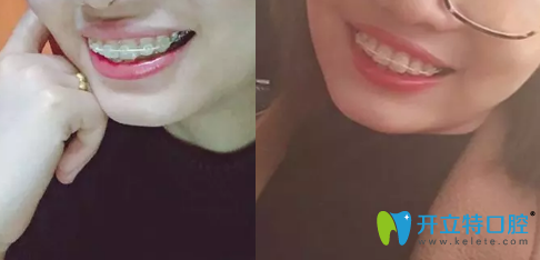 陈炳霖做牙齿矫正后两个月的照片