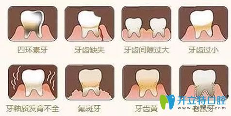 牙贴面能修复哪些问题牙齿