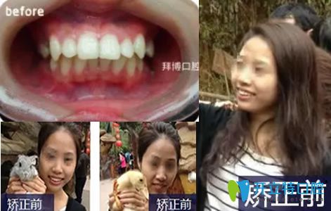 无锡拜博口腔陈炳霖做牙齿矫正美白前照片