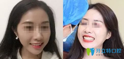 无锡拜博口腔牙齿矫正一年效果图