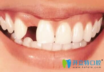 牙齿少一半？看女白领在济宁玉红口腔做牙齿修复的全过程