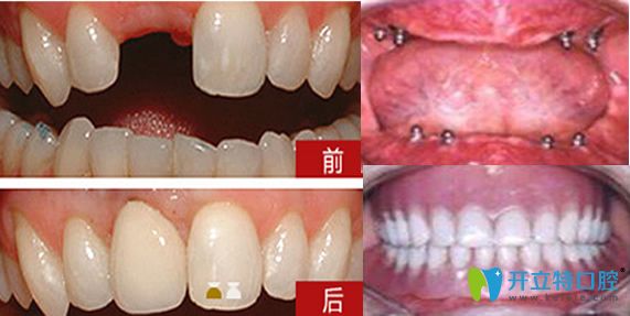 重庆牙博士口腔陈泽旭牙齿种植案例前后效果对比图