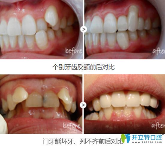 重庆牙博士口腔叶金平牙齿修复案例对比图