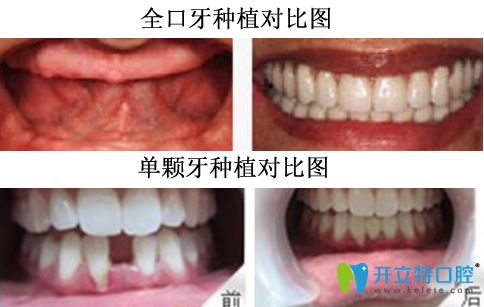 重庆牙博士口腔李荣院长种植牙案例对比图
