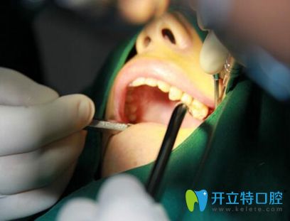 蛀牙导致牙齿缺失 女白领在合肥佳德口腔15分钟做好种植牙