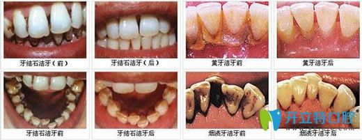 洗牙要选专业 扬州菲特口腔超声波洁牙更安全