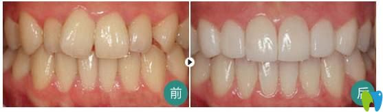费丽敏主任牙齿不齐矫正案例 费丽敏主任牙齿不齐矫正案例