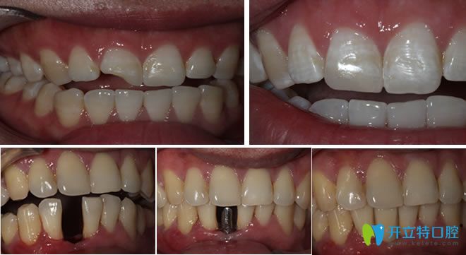 赣州立勤口腔牙修复和种植牙案例