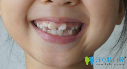 淄博盛德仁口腔医生科普：儿童牙齿矫正年龄较佳年龄