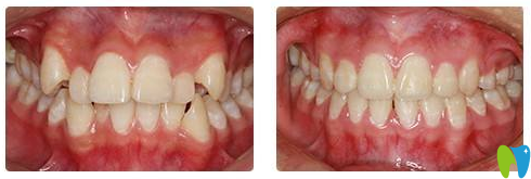 广州拜博口腔牙齿矫正案例对比图