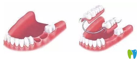 传统义齿修复