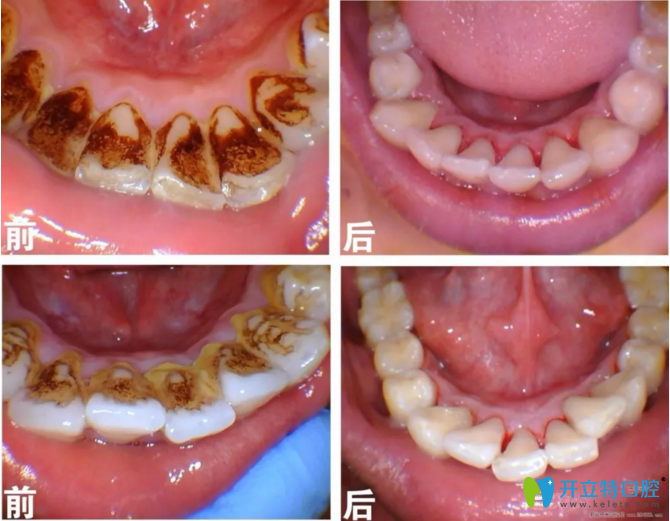 超声波洁牙对比案例