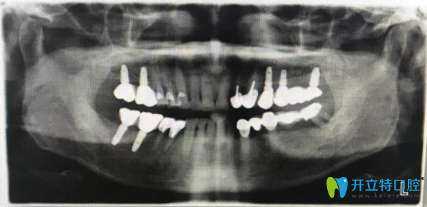 真人案例：能够代替真牙使用的种植牙在X光片下是这样子