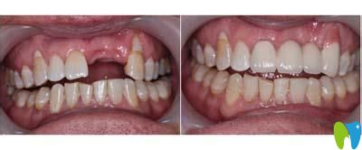 同泰口腔种植牙齿案例
