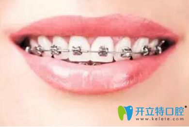 舟山健宁牙齿矫正器种类有哪些？牙齿矫正期间如何刷牙？