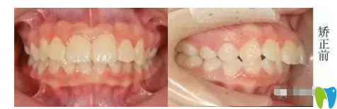 牙齿矫正术前是龅牙