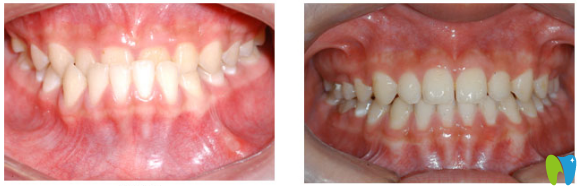 广州拜博口腔牙齿反颌正畸治疗案例对比图
