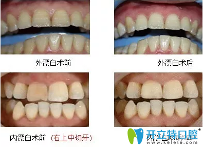 漂白牙对比案例