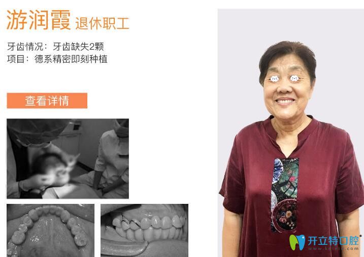 圣洁口腔牙齿缺失精密种植案例 圣洁口腔牙齿缺失精密种植案例