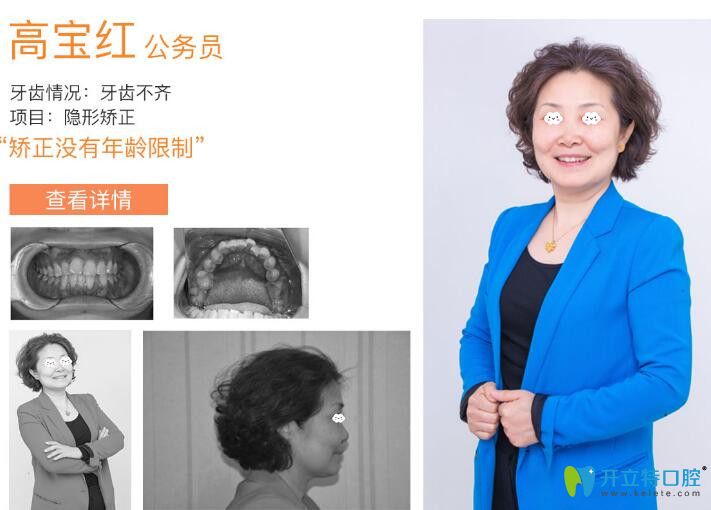 圣洁口腔牙齿不齐隐形矫正案例 圣洁口腔牙齿不齐隐形矫正案例