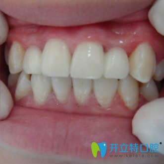 在邯郸贝洁做隐形牙齿矫正两年后恢复效果