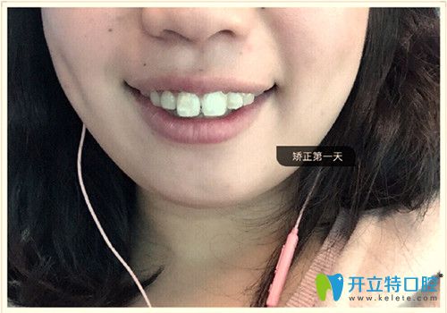 带上隐形牙套天