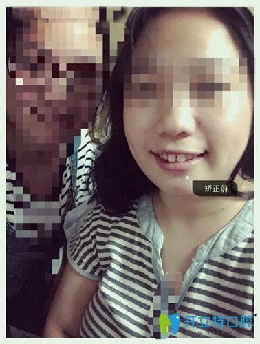 矫正之前牙齿不整齐