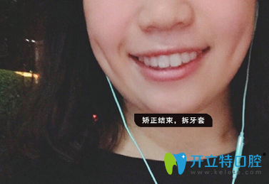 经过1年1个月时间牙齿矫正整齐