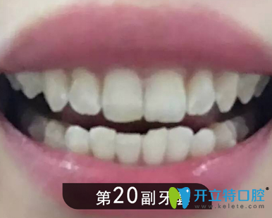 矫正1年后牙齿明显整齐