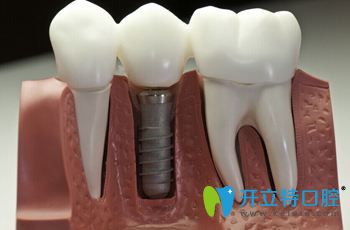 维乐口腔医生告诉你：无痛种植牙有什么优势?