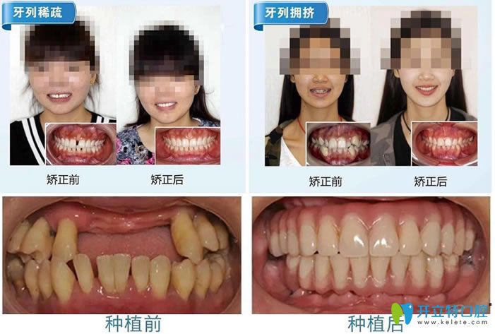 南京丹德齿科种植牙和牙齿矫正案例 南京丹德齿科种植牙和牙齿矫正案例