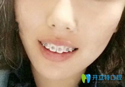九江奇洋口腔牙齿正畸第1天照片 九江奇洋口腔牙齿正畸第1天照片