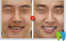 常德口腔医院牙齿缺失不齐到常德口腔做了3D数码隐形正畸术告别自卑案例