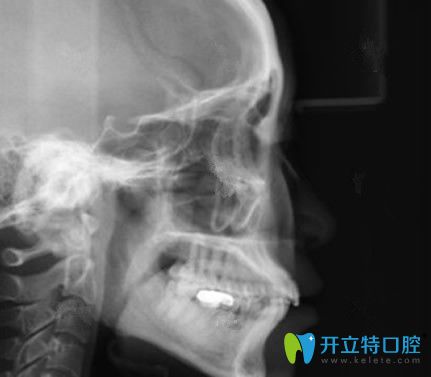 惠州致美口腔牙齿矫正前拍的X光片