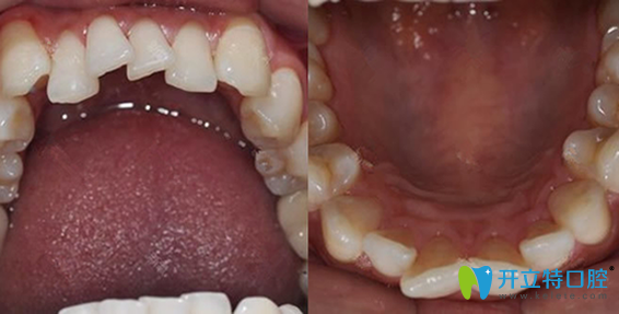 牙齿错乱在惠州致美口腔做了隐性矫正,三个月效果就很明显