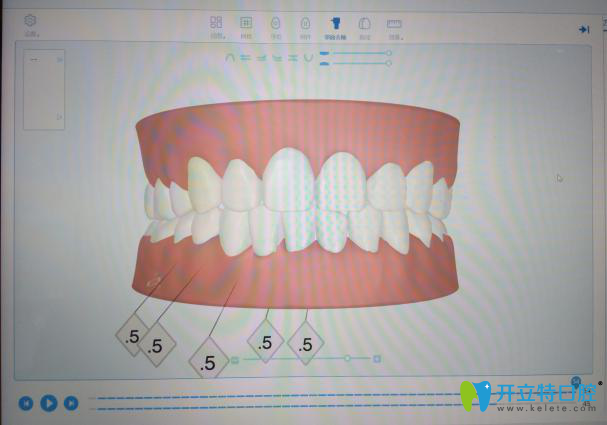 矫正牙齿咸宁中山口腔采用3D建模型