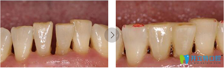 牙周纤维丝固定前后对比