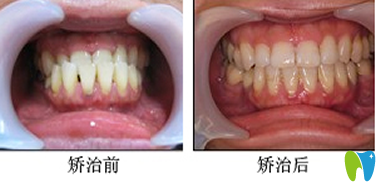 拜博拜尔口腔杨国平医生隐形矫正牙齿效果图