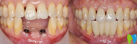 宁波拜博拜尔口腔吉东种植牙效果对比图